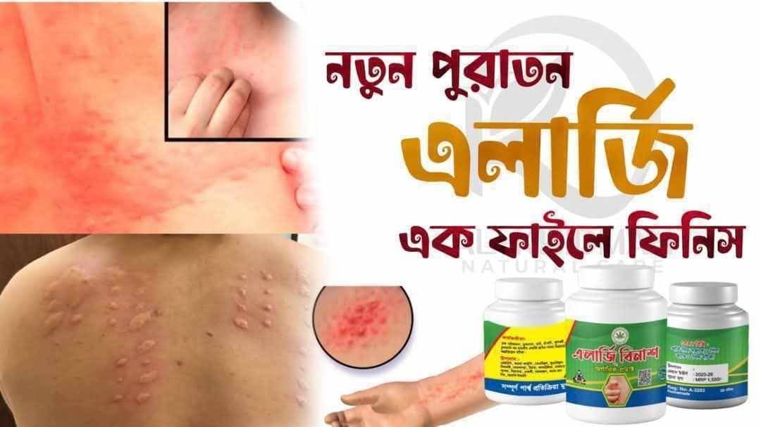 এলার্জি বিনাশ 3