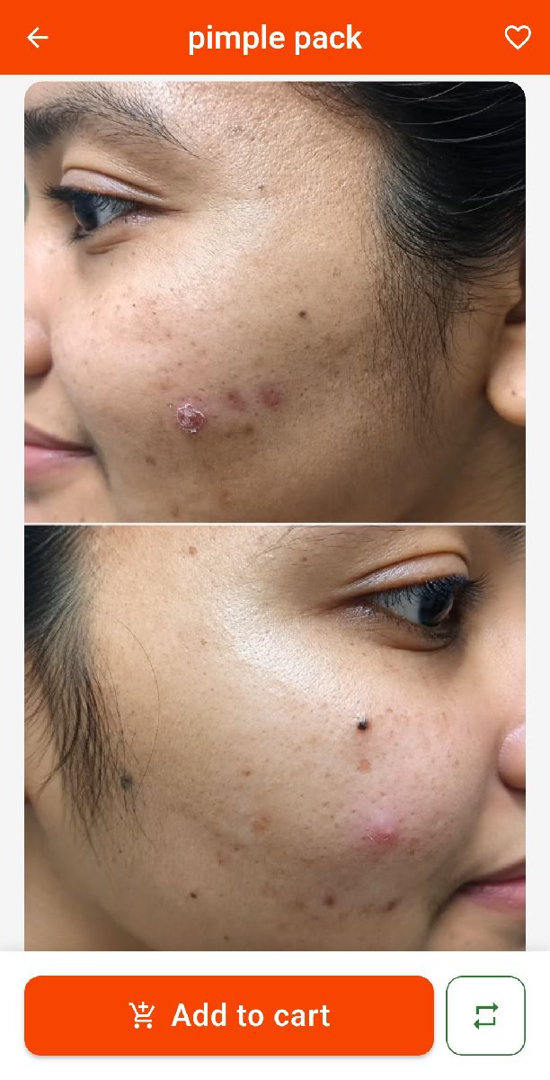 pimple pack